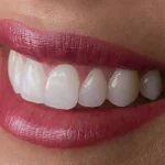 Ups and downs of veneers